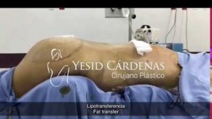 'Cambio con una Lipotransferencia Medellin Colombia'